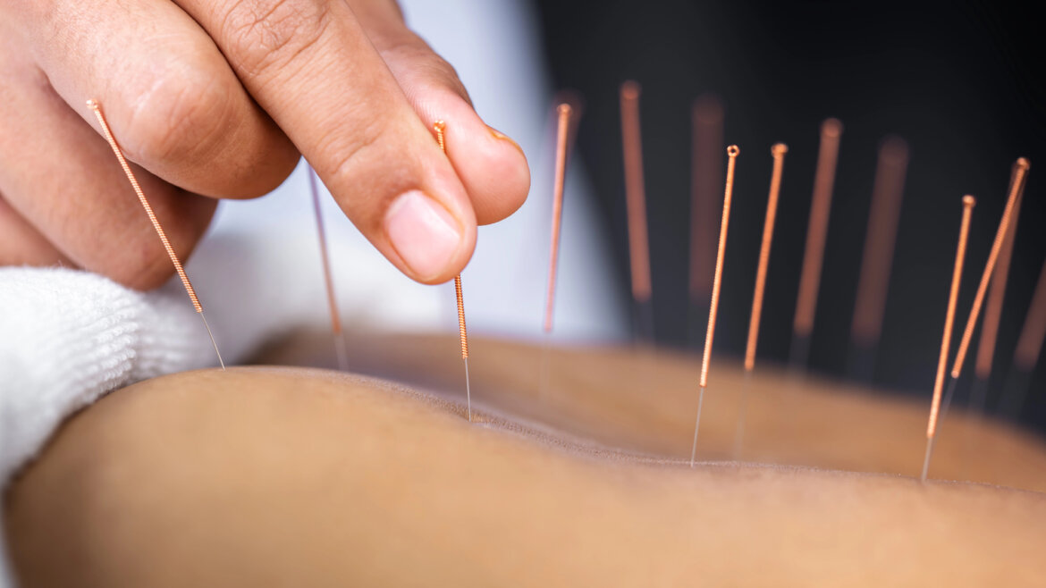 Acupuncture