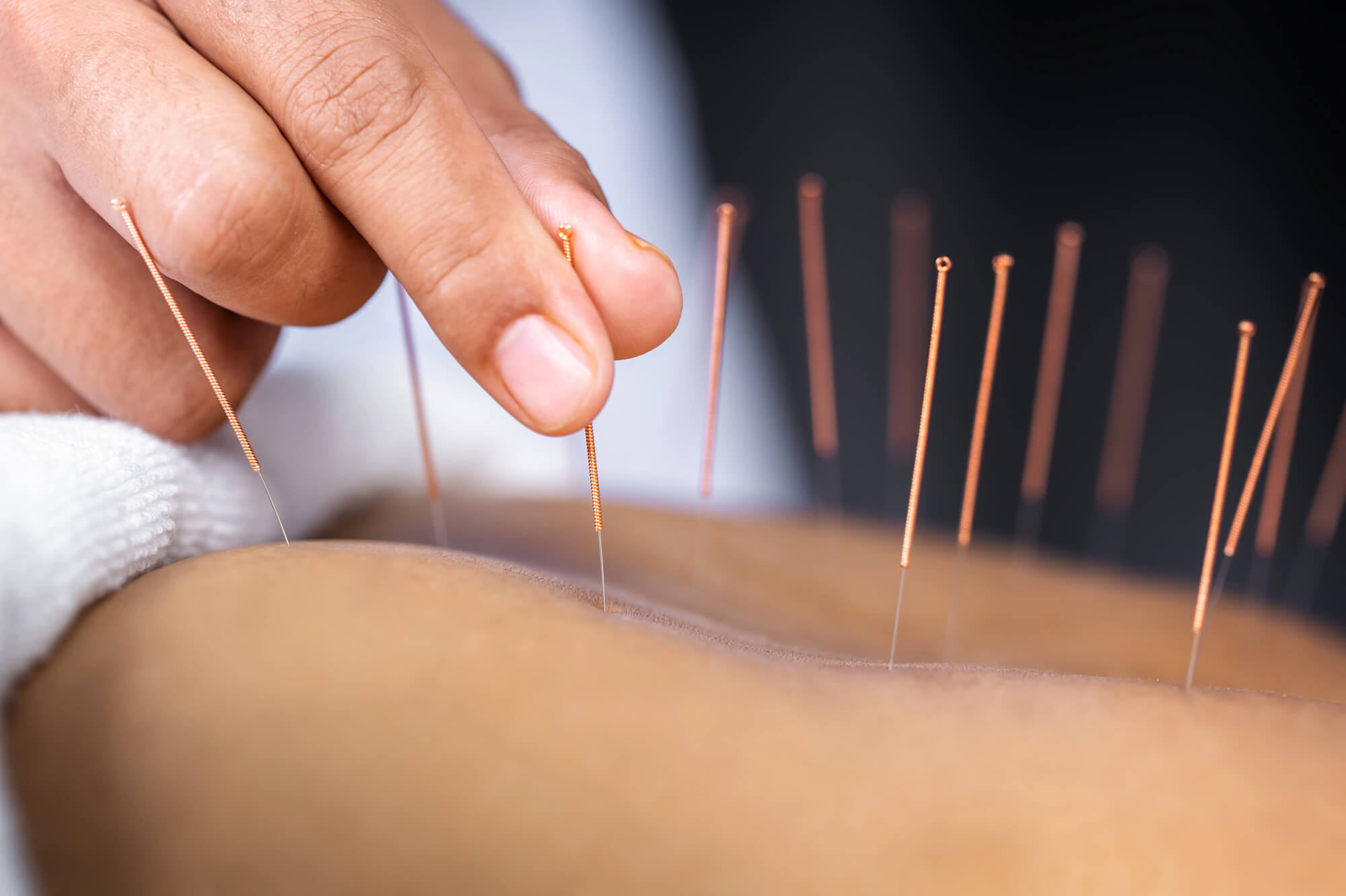 Acupuncture in Rockledge, FL